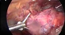 VATS- thymectomy anatomy