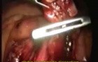 Laparoscopic Para-Aortic Lymphnode Dissection