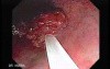 Tubulo - Villous Rectal Adenoma - Endoscopy (9 of 35)