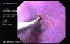 Hemorrhage due status post rubber band ligation of esophageal varices (8 of 25)