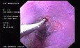 Hemorrhage due status post rubber band ligation of esophageal varices (8 of 25)
