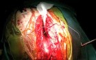 Median Sternotomy Closure Technique