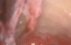 Revision Mastoidectomy 3: Middle Ear Dissection, Air Pathways