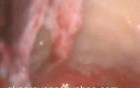Revision Mastoidectomy 3: Middle Ear Dissection, Air Pathways