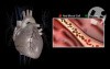 Normal Coronary Anatomy and Physiology