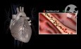 Normal Coronary Anatomy and Physiology