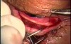 Entropion surgery for upper lid using Fugo Blade
