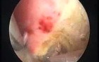 New Resection Master Systeme And Endometrial Ablation