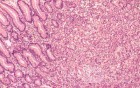 Gastric Cancer (13 of 15)