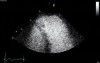 Arrhythmogenic Right Ventricular Cardiomyopathy