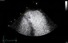 Arrhythmogenic Right Ventricular Cardiomyopathy