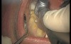 Upper Arch Teeth Preparation And Provisional Crowns (3/5)
