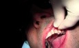 Graft Suturing - Gingival Grafting #11-12