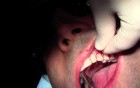 Graft Suturing - Gingival Grafting #11-12