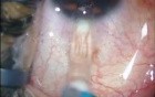 ICL Implantation In High Myopic Case With Thin Cornea