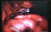 Jejunal Gastrointestinal Stromal tumor (GIST) (31 of 86)
