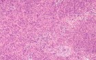 Gastrointestinal Stromal tumor (GIST) (57 of 65)