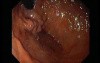 Gastric Varices - Endoscopic Ablation With Cyanoacrylate Glue (4 of 18)