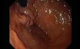 Gastric Varices - Endoscopic Ablation With Cyanoacrylate Glue (4 of 18)