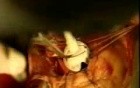 Valve Replacement Surgery