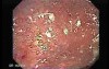 Ulcerative Colitis Complicating Colon Cancer (3 of 4)