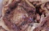 Rectal Adenocarcinoma that infiltrates the second and the 
 third valve (5 of 5)