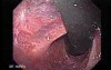 Long Standing Alcohol Abuse - Multiple Scars After Banding