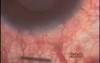 Glaucoma - operation with Fugo Blade