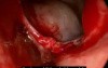 Endoscopic Removal Of Ethmoid Mucocele
