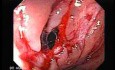 Consecutive colonoscopy with dilation was carried out (13 of 15)