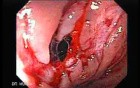 Consecutive colonoscopy with dilation was carried out (13 of 15)