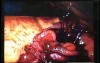 Jejunal Gastrointestinal Stromal tumor (GIST) (46of 86)