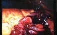 Jejunal Gastrointestinal Stromal tumor (GIST) (46of 86)