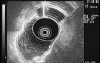 Endoscopic Ultrasound (EUS) of Gastric Body (1 of 2)