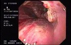 Laryngeal carcinoma invading epiglottis and tongue 1/2