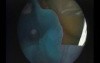 Hypoplastic Maxillary Sinus Type 2 - Endoscopic Drainage