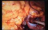 Jejunal Gastrointestinal Stromal tumor (GIST) (44 of 86)