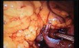 Jejunal Gastrointestinal Stromal tumor (GIST) (44 of 86)