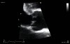 Acute Aortic Regurgitation