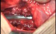 Perforation of a Esophageal Carcinoma after the procedure with hydrostatic balloon dilation (8 of 12)