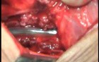 Perforation of a Esophageal Carcinoma after the procedure with hydrostatic balloon dilation (8 of 12)