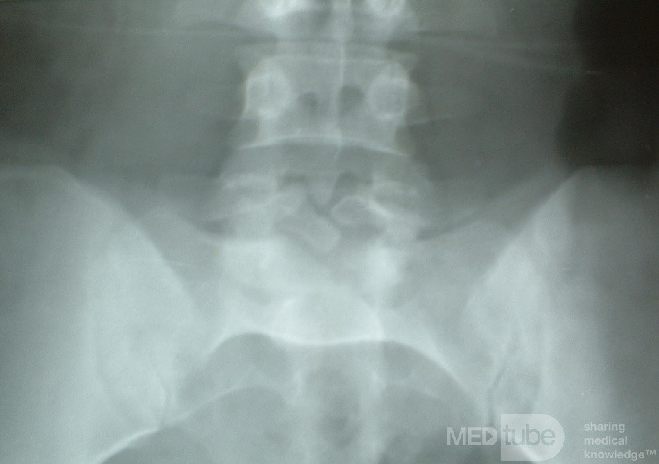 Spina Bifida Oculta