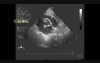 Multiple Cardiac Rhabdomyoma - 1