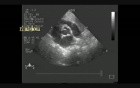 Multiple Cardiac Rhabdomyoma - 1