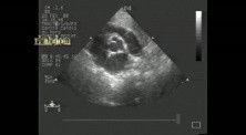Multiple Cardiac Rhabdomyoma - 1