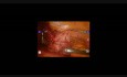 Robotic Revision of Failed VGB to Roux-en-Y Gastric Bypass