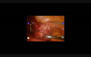 Robotic Revision of Failed VGB to Roux-en-Y Gastric Bypass