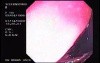 Rectal Endoscopy - Adenocarcinoma (3 of 3)