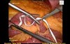 Laparoscopic Choledochal cyst 