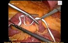 Laparoscopic Choledochal cyst 